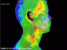lymphe thermal imaging