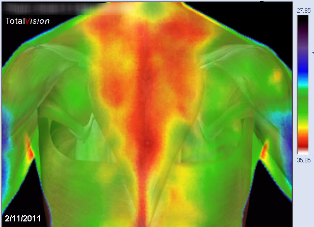 medical thermography traps