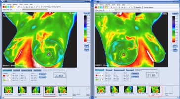 medical thermography breast screening